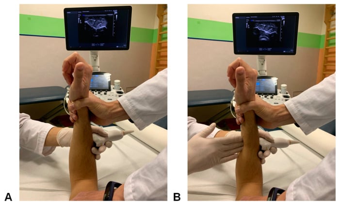 Clinical performance of the interosseous membrane hernia sign test with dorsal ultrasound probe