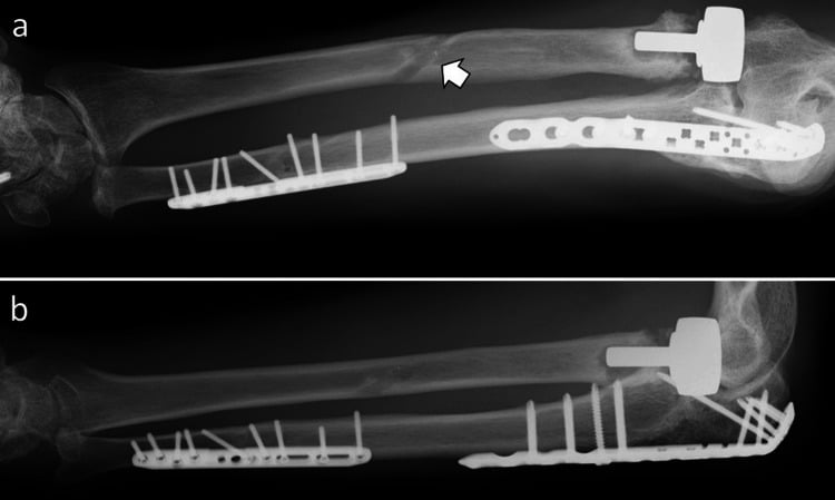 Final full-length forearm radiographs after radial head replacement, fixation and interosseous membrane reconstruction