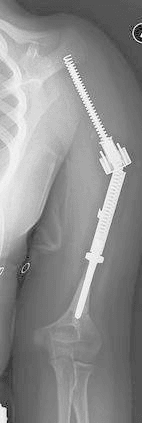 Broken expansion mechanism in proximal humeral expandable prosthesis