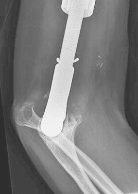 Elbow dislocation after distal humeral endoprosthesis
