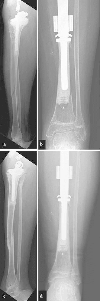 Periprosthetic tibial fractures managed non-operatively with healing