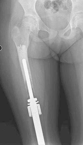 Radiograph showing aseptic loosening around the proximal stem of an expandable femoral endoprosthesis
