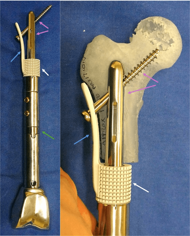 Custom distal femur endoprosthesis showing stem collar extracortical plate and interchangeable length-adjustment collars