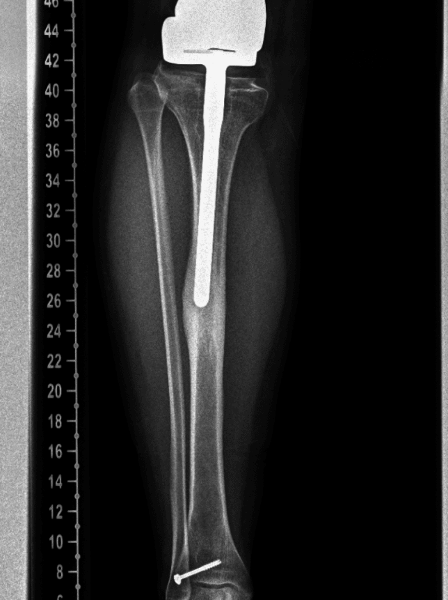 Long-leg radiograph showing varus deformity and stem migration eight years after expandable distal femur reconstruction