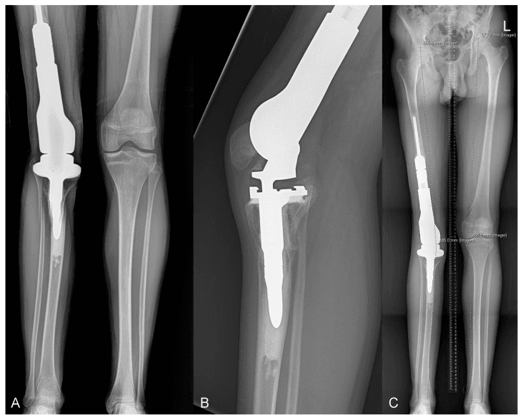 Serial long-leg and knee radiographs after repeated lengthening of a GMRS expandable distal femur prosthesis