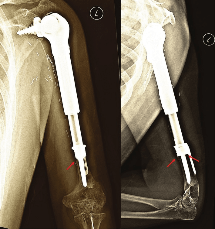 Anteroposterior and lateral radiographs of a proximal humeral extendable endoprosthesis showing the stem collar cortical interface