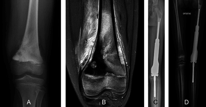 Preoperative radiograph and MRI of distal femoral osteosarcoma with postoperative expandable modular prosthesis radiographs