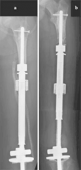 Radiographs of a femoral REPIPHYSIS prosthesis before expansion and at maximum implant length