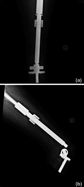 Anteroposterior and lateral radiographs of a paediatric REPIPHYSIS expandable endoprosthesis