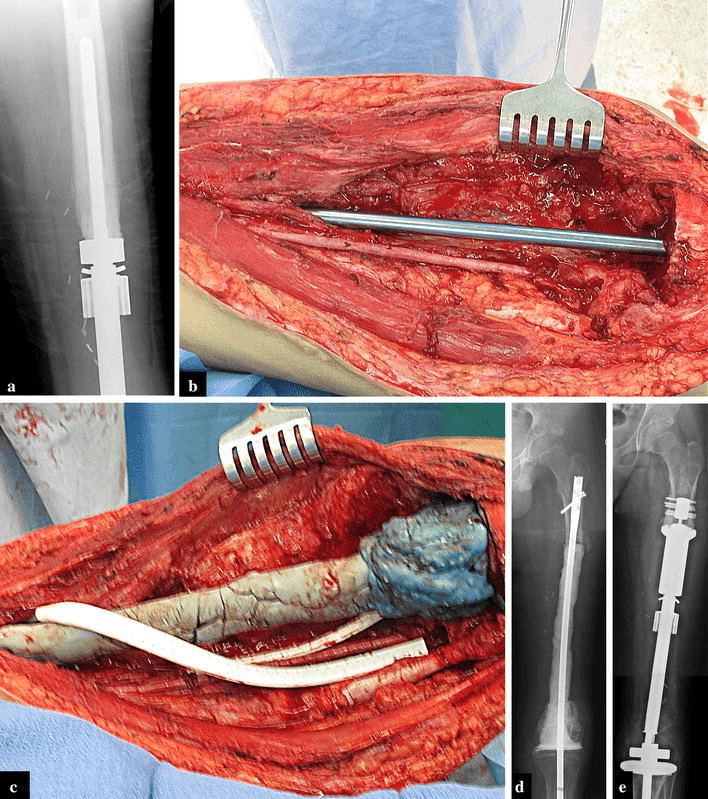 Radiographic and operative sequence showing septic loosening implant removal antibiotic spacer and reimplantation