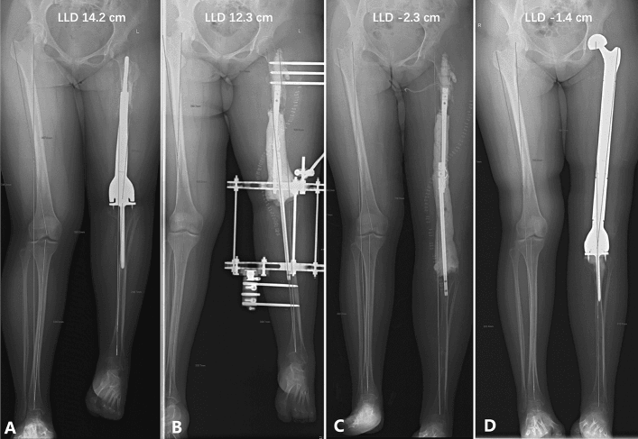 Serial full-length radiographs showing staged correction of severe limb-length discrepancy after childhood tumour prosthesis