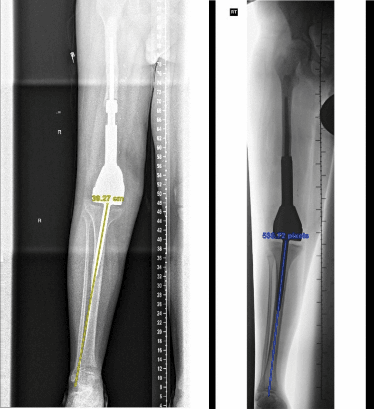 Serial scanograms showing progressive tibial stem migration and varus deformity in a child