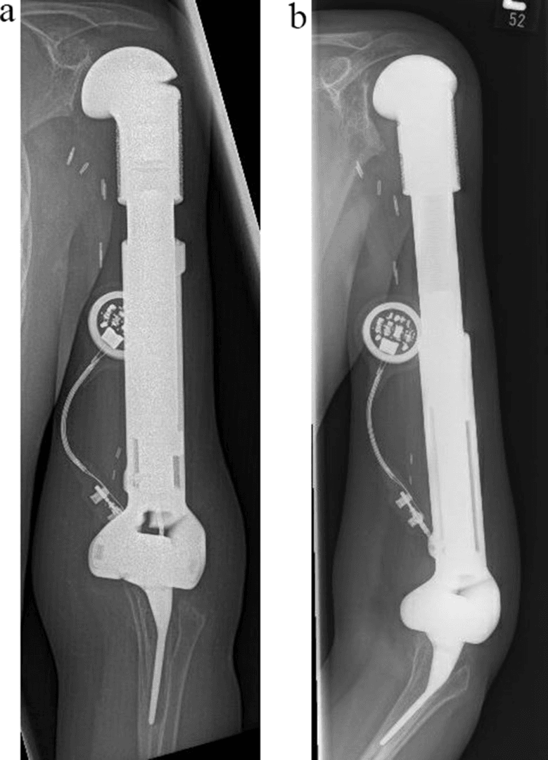 Paediatric humeral Xpand prosthesis radiographs at the beginning and completion of elongation