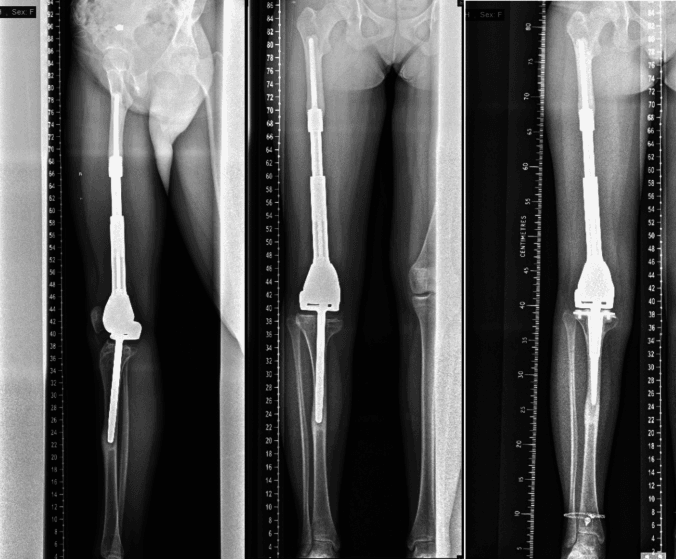 Serial full-length radiographs showing cortical hypertrophy stress shielding and tibial fixation revision after expandable distal femur reconstruction