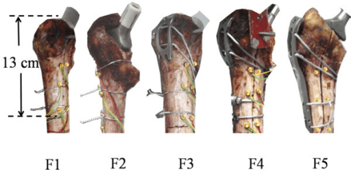 Diagram of five trochanteric fixation constructs using wires, cables and claw plates.