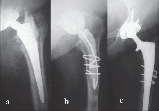 Serial hip radiographs showing an infected loose bipolar prosthesis and an antibiotic cement spacer after first-stage revision.