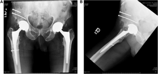 AP and lateral post-operative hip radiographs showing a revision femoral stem with screw and cerclage fixation of osteotomies.