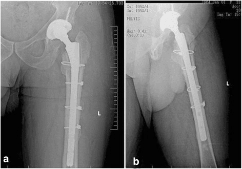 AP and lateral hip radiographs of a cementless modular revision stem with a fixed trochanteric osteotomy flap.