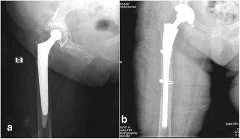 Paired hip radiographs showing a loose cemented total hip replacement and the revision result.