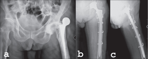 Pre-operative pelvic radiograph showing a dislocated cemented hip replacement and post-operative AP and lateral views after revision.