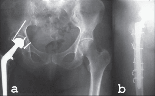 Pre-operative and four-month post-operative AP radiographs of a right hip revised to a cementless stem.