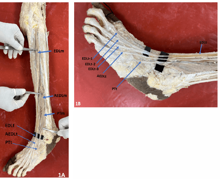 Cadaveric dissection of the leg and foot (panels 1A and 1B) labelling the main and accessory EDL bellies and tendons, peroneus tertius, and three EDL tendon slips