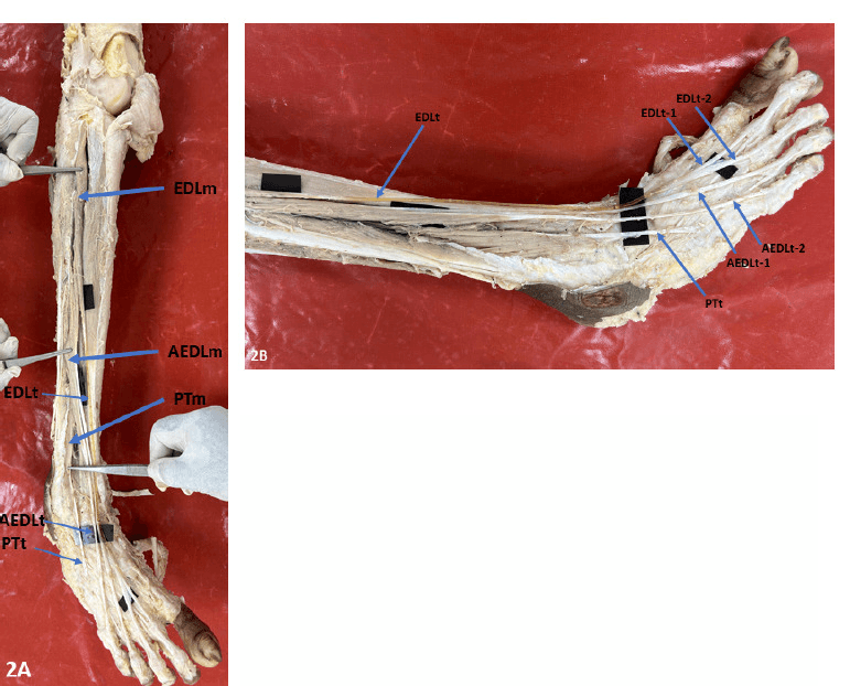 Cadaveric dissection of the leg and foot (panels 2A and 2B) labelling the main and accessory EDL, peroneus tertius, two EDL tendon slips and two accessory EDL tendon slips
