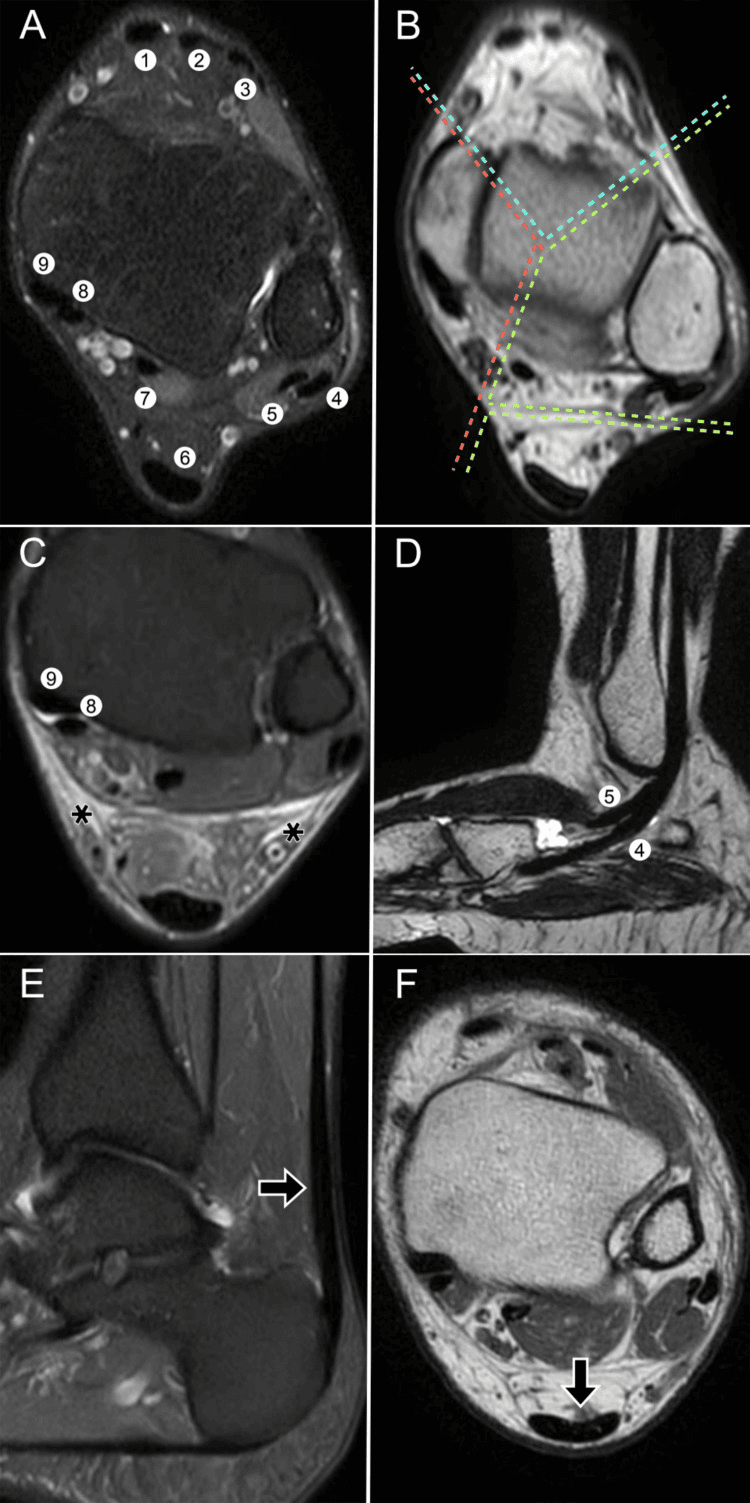 Six-panel ankle MRI (A-F) with numbered tendons on the cross-sectional panels, coloured dashed lines dividing the compartments in panel B, and arrows in panels E and F