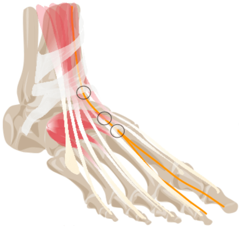Schematic of the deep peroneal nerve on the dorsum of the foot marking potential compression sites beneath the inferior extensor retinaculum and extensor hallucis brevis