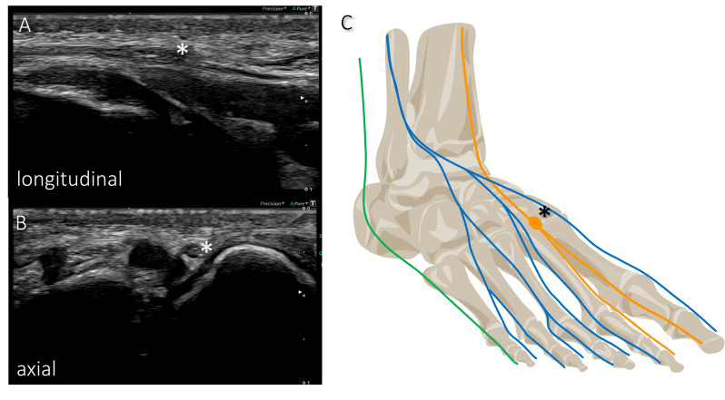 Longitudinal and axial ultrasound of the deep peroneal nerve with a corresponding dorsal-foot nerve schematic