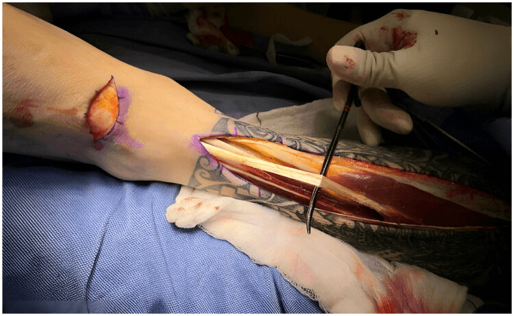 Intraoperative view of extensor digitorum longus exposed through a long incision, the tendons lying over the muscle belly with an instrument passed beneath them before harvest
