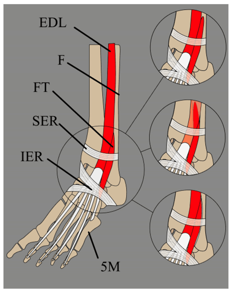 Schematic of extensor digitorum longus and fibularis tertius passing beneath the superior and inferior extensor retinacula, with three insets showing different arrangements of the two muscles at the ankle