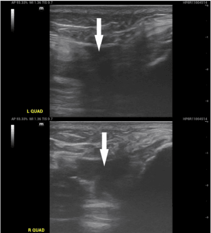 Bilateral point-of-care ultrasound showing quadriceps tendon discontinuity and haematomas
