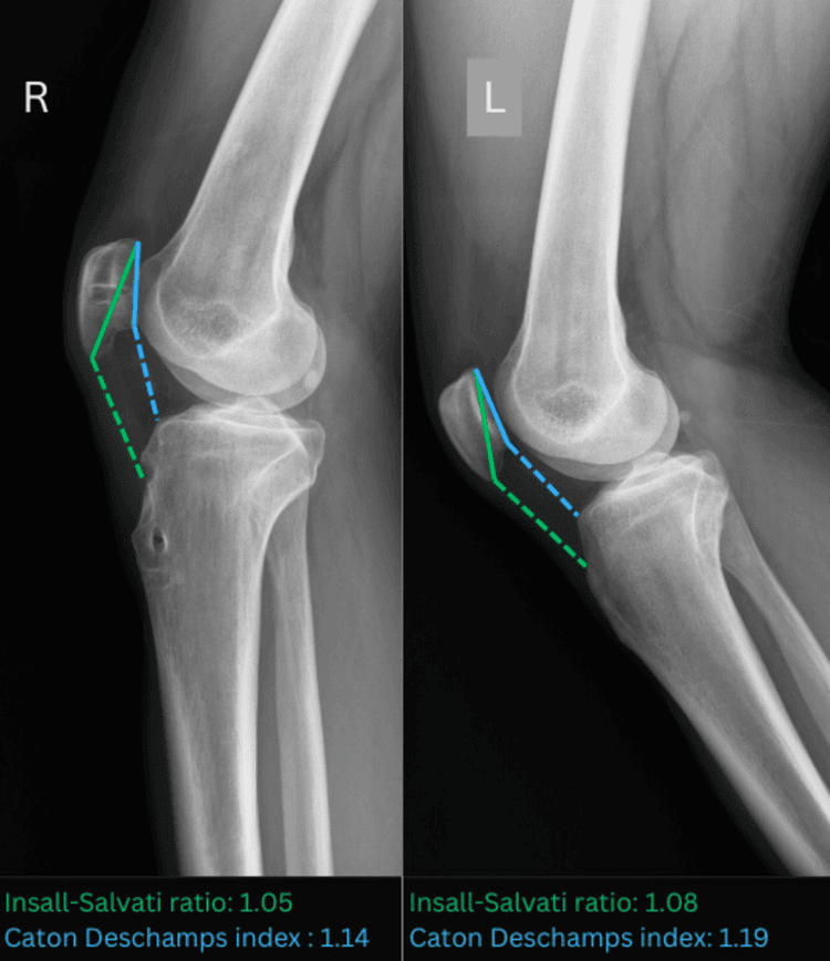 Paired lateral radiographs of the right and left knees with Insall-Salvati and Caton-Deschamps measurement lines; printed values Insall-Salvati 1.05 and Caton-Deschamps 1.14 on the right, 1.08 and 1.19 on the left