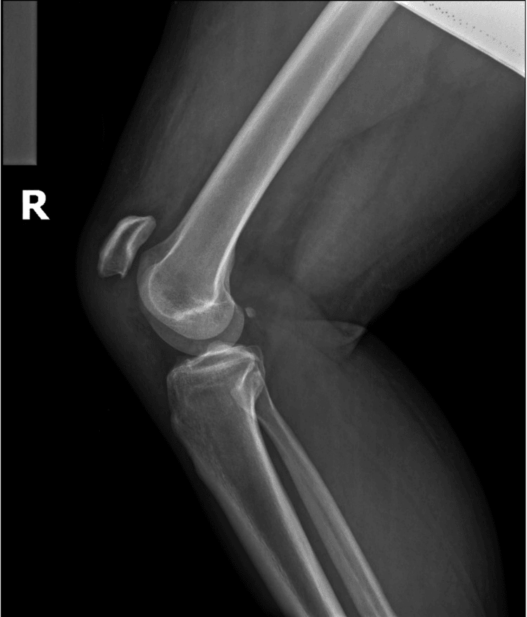 Lateral knee radiograph showing patella alta with patellar tendon rupture