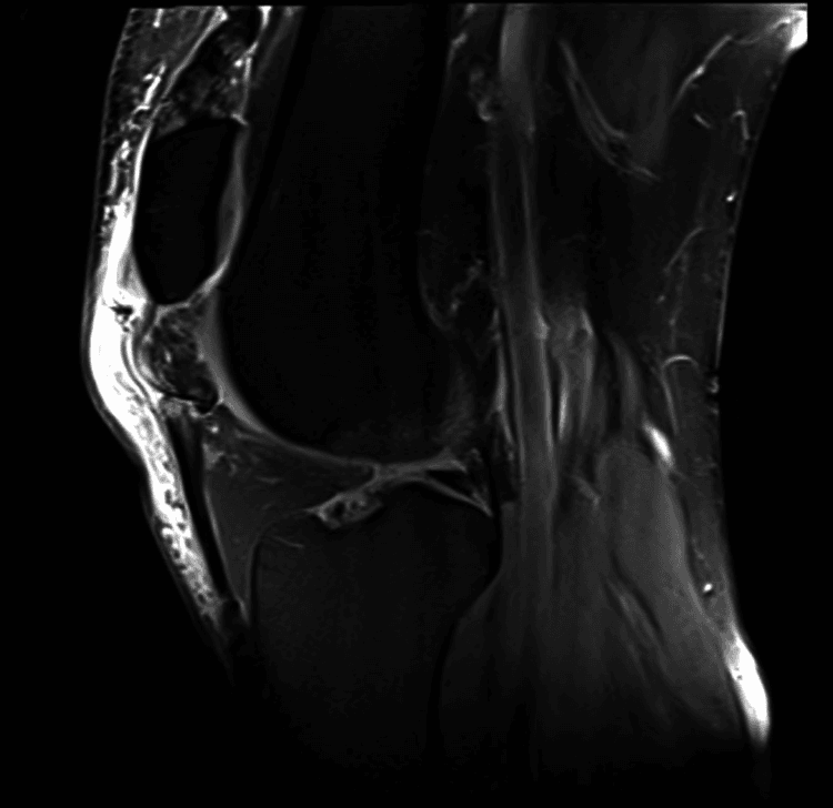 Sagittal knee MRI showing complete midsubstance patellar tendon rupture