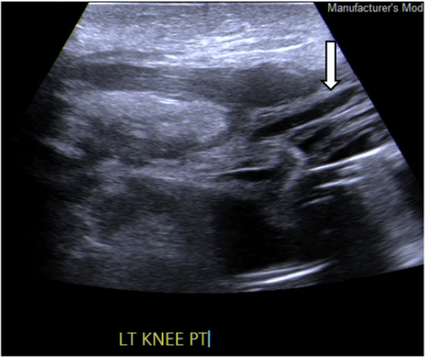 Long-axis ultrasound of a left knee labelled LT KNEE PT, with an arrow marking a patellar tendon rupture retracted from the tibial tubercle