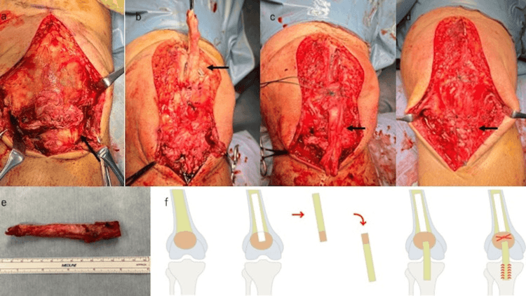 Operative photographs (a to d), the harvested graft beside a ruler (e) and a schematic sequence (f) of patellar tendon reconstruction with a quadriceps tendon-patellar bone autograft