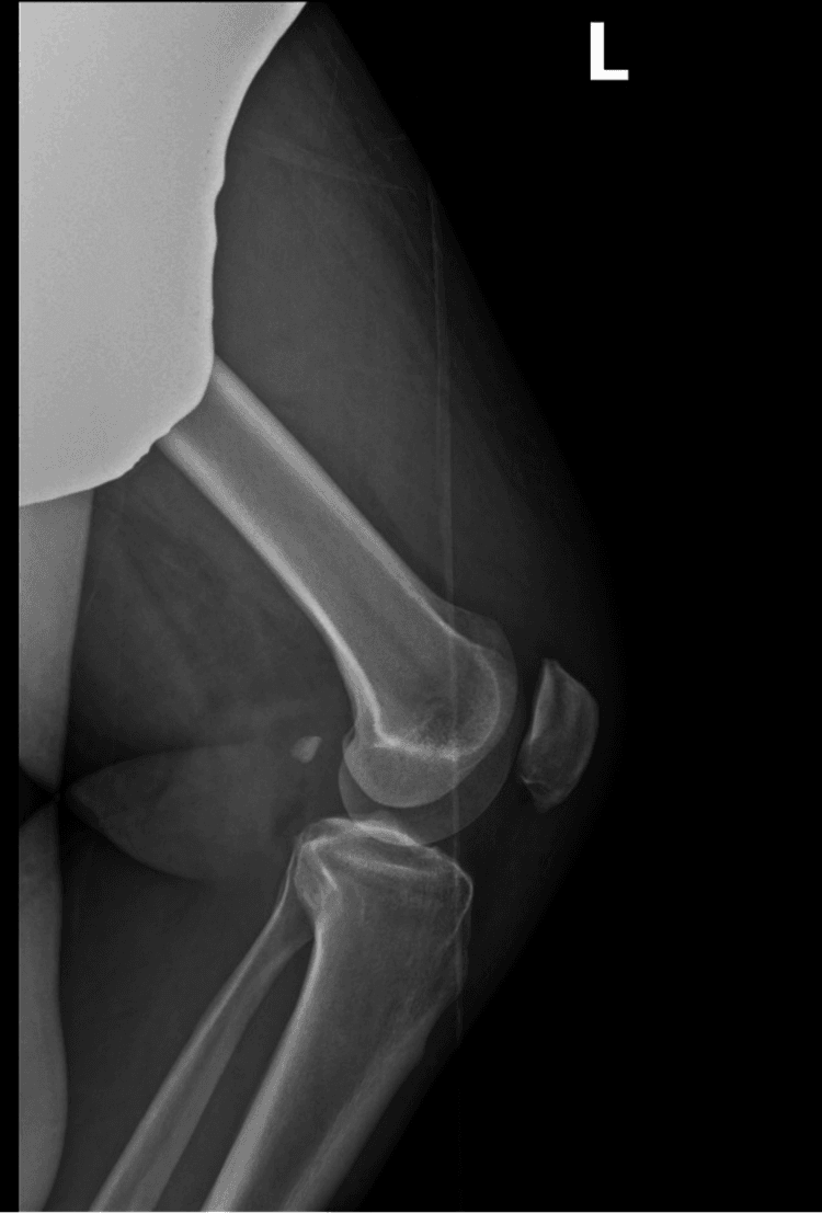 Lateral knee radiograph showing patella baja with quadriceps tendon rupture