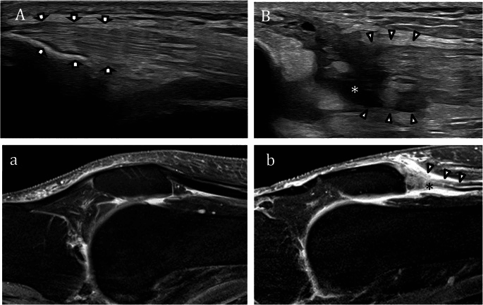 Four panels comparing a normal quadriceps tendon (ultrasound A, sagittal MRI a) with a completely torn quadriceps tendon (ultrasound B, sagittal MRI b), arrowheads and asterisks marking the tear