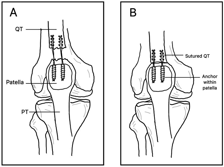 Two-panel anterior schematic of suture-anchor quadriceps tendon repair, with anchors in the superior patella holding sutures from the quadriceps tendon