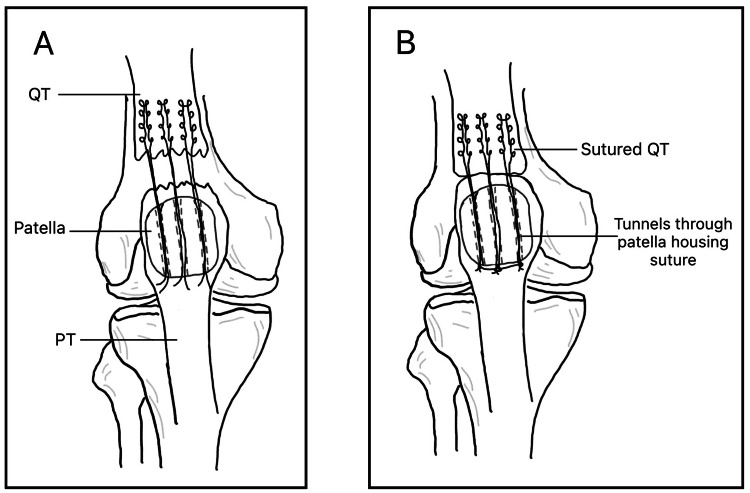 Two-panel anterior schematic of transosseous quadriceps tendon repair: sutures in the quadriceps tendon passed through tunnels in the patella (A) and the sutured tendon with the tunnels housing the suture (B)