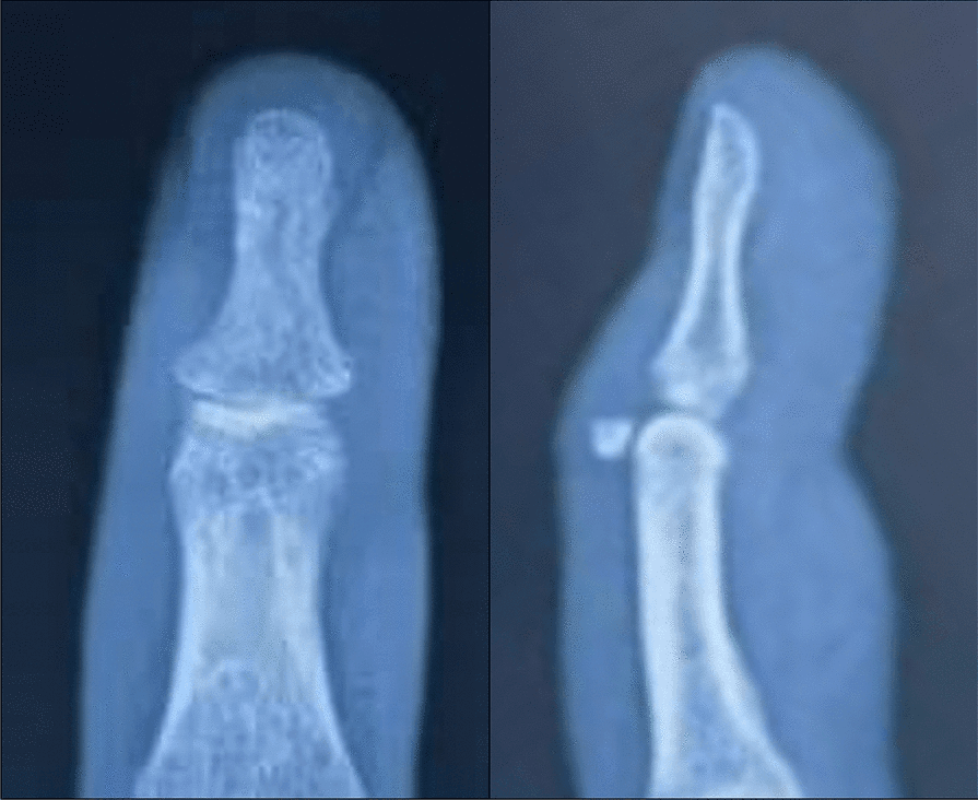 AP and lateral radiographs of a bony mallet, the lateral showing a small dorsal fragment at the DIP joint