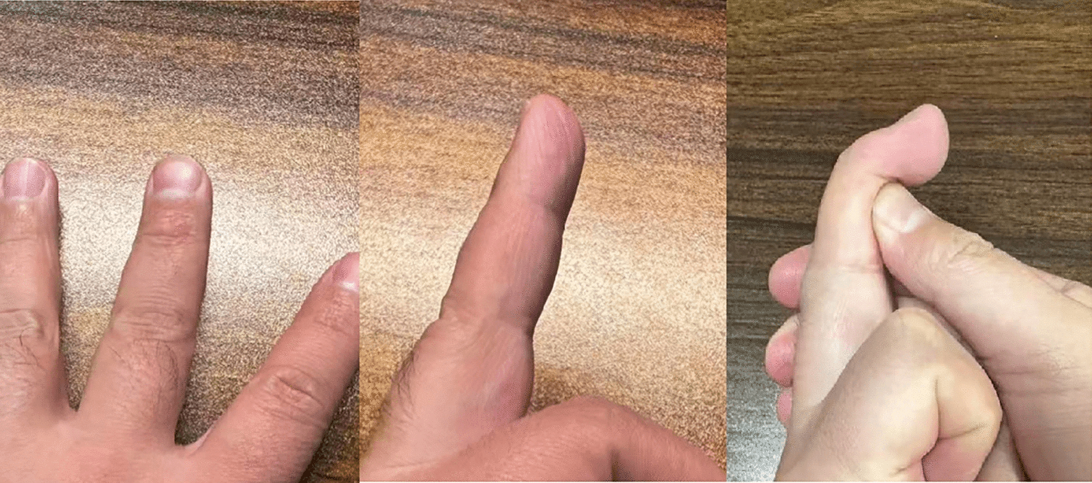Clinical extension and flexion six months after bony mallet fixation