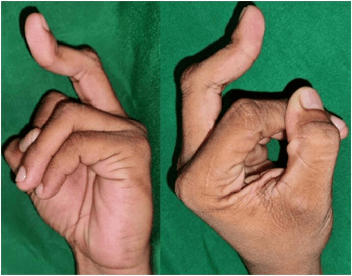 Clinical chronic boutonniere deformity of the middle finger, two views