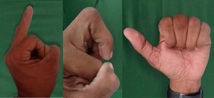 Active finger extension and flexion one year after boutonniere reconstruction