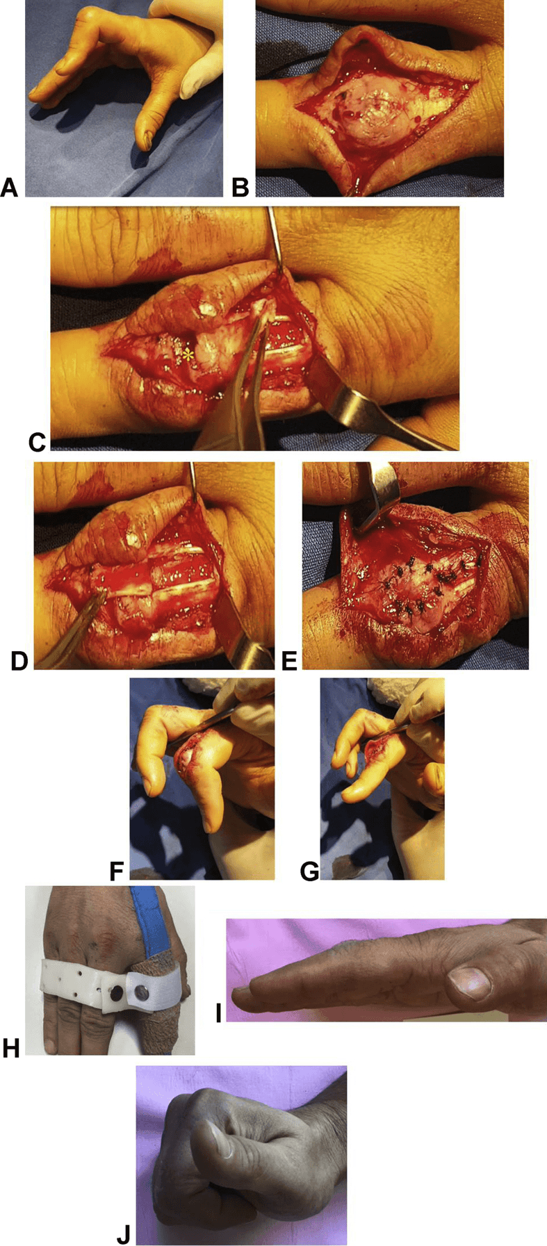 Wide-awake boutonniere reconstruction with tendon flap and relative-motion simulation, panels A to J, from deformity to follow-up