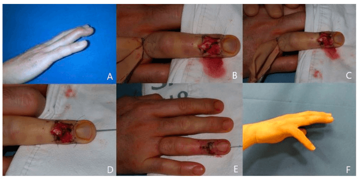 Direct tendinous mallet repair with paratenon closure and twelve-month outcome, panels A to F