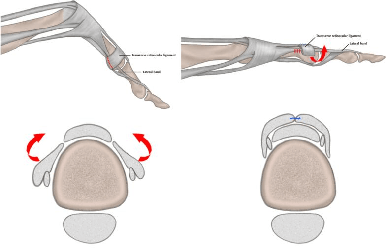 Schematic of lateral band relocation: side views of the finger with the transverse retinacular ligament and lateral band labelled, and cross-sections of the lateral bands rotated dorsally and sutured