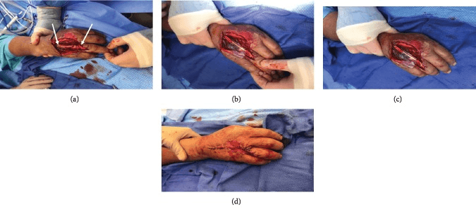 Zone V extensor reconstruction with tendon autograft and soft-tissue membrane